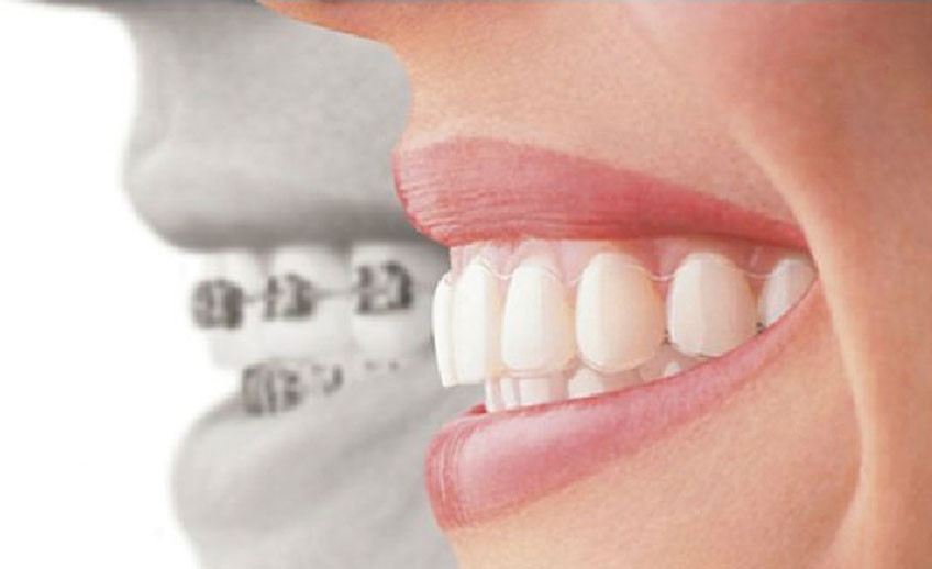 ORTHODONTIC Treatment In Vadodara